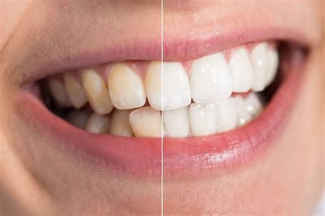 The Different Types Of Teeth Stains And How To Remove Them