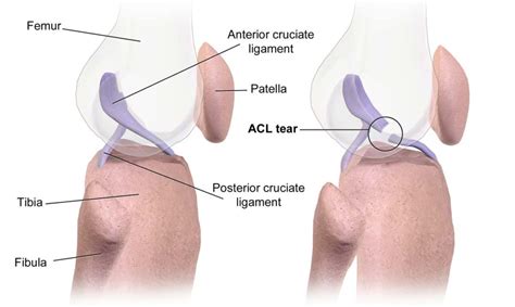 Anterior Cruciate Ligament Acl Injury Sports Medicine Information