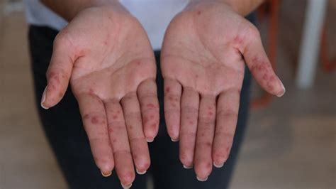 Hand Foot And Mouth Disease In Adults Symptoms And Treatment Hand