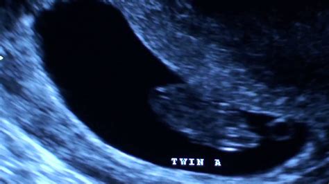 8 Weeks 5 Days Ultrasound Twins Youtube