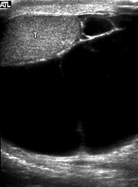 Us Of Acute Scrotal Trauma Optimal Technique Imaging Findings And