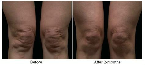 Tighten The Skin Around Your Knees Non Surgically With Thermage Skin