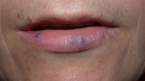 How To Treat Patches On Lips Sitelip Org