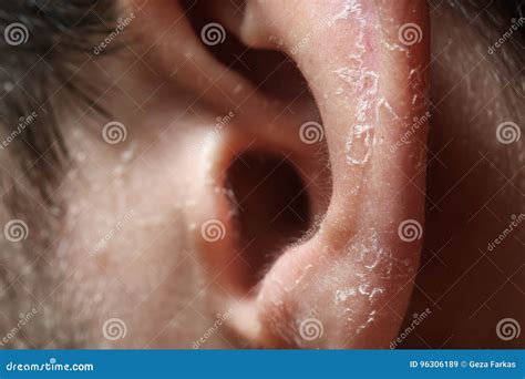 Epidermis Peel On The Ear After Sunburn Stock Image Image Of Health