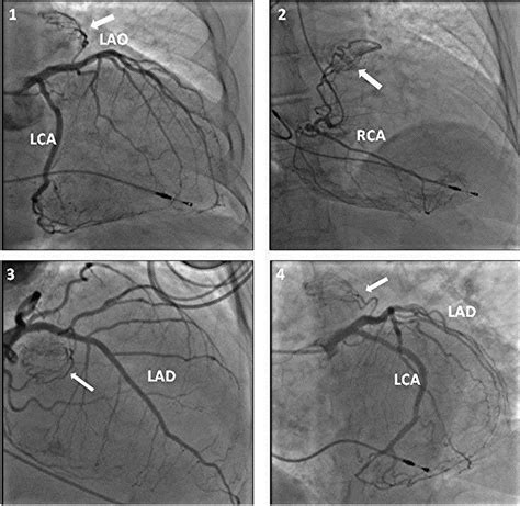 Cardiac Catheterization