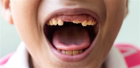 Rotten Teeth In Children Stock Photos Pictures And Royalty Free Images