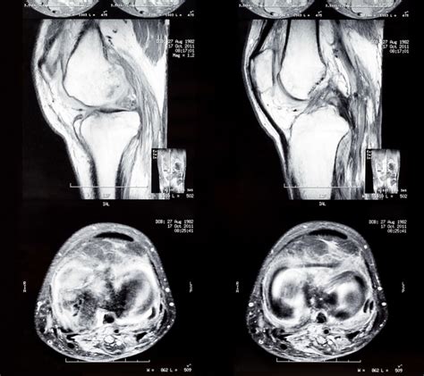 What Is A Knee Ct Scan Two Views