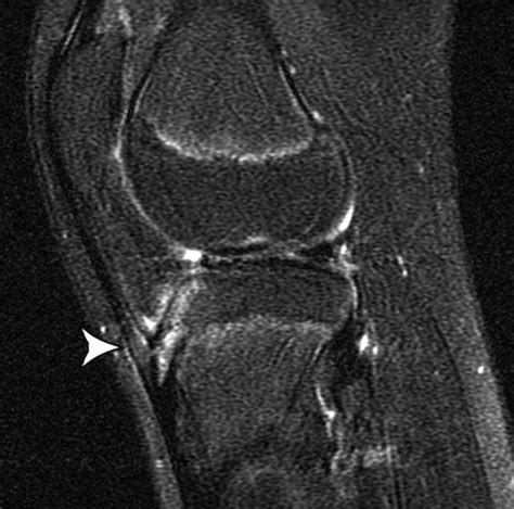 Injuries And Conditions Of The Extensor Mechanism Of The Pediatric Knee
