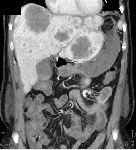 Liver Metastases From A Carcinoid Tumor Liver Case Studies Ctisus