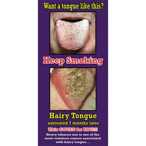 Hairy Tongue Poster Nimco Inc Prevention Awareness Supplies