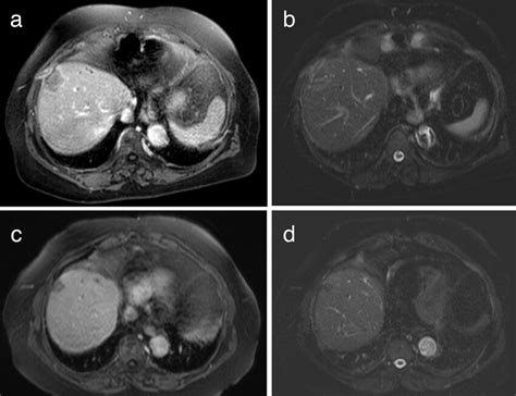 Costochondritis After RFA Of HCC A Patient With Segment 8 HCC Who