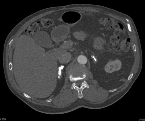 Calcified Adrenal Glands Due To Prior Tuberculosis Tb Adrenal Case