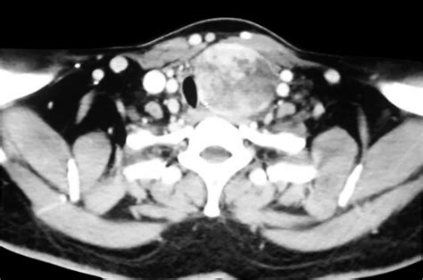 Risk Of Malignancy In A Multinodular Goiter Report Of Two Cases With A