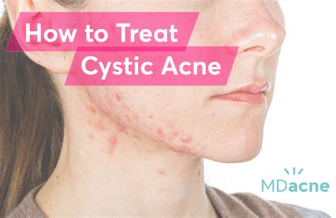 How To Prevent Cystic Pimples Behalfessay9