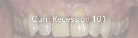 What Causes Gum Recession Causes Prevention And Treatments