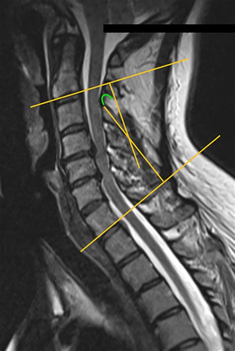 Mri Cervical Spine Neck Pain