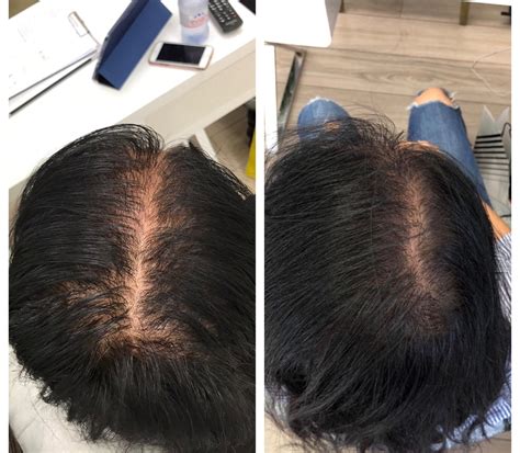Prp Hair Treatments In London See Our Before And Afters — The Prp Lab