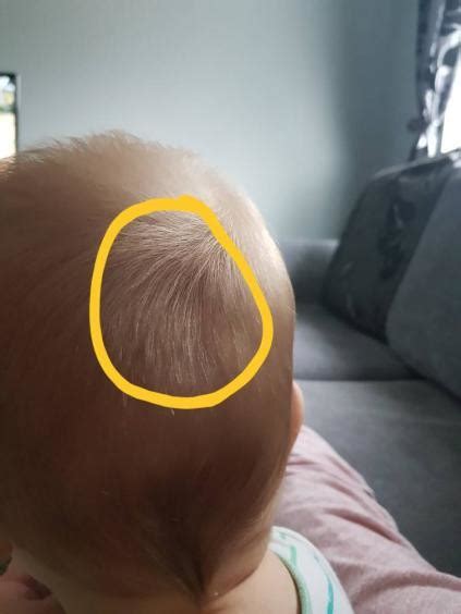 Indent On 7 Month Olds Head