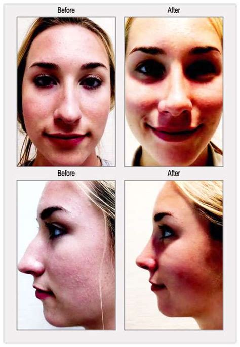 Cosmetic Rhinoplasty Surgeons Philadelphia Facial Plastic Surgery