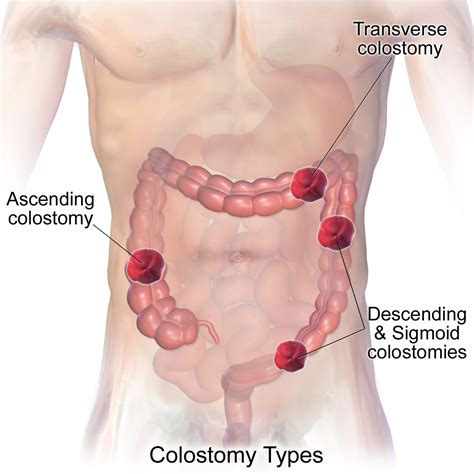 The colonoscope is inserted into the rectum. Colostomy - How To Change A Colostomy Bag & Living With It