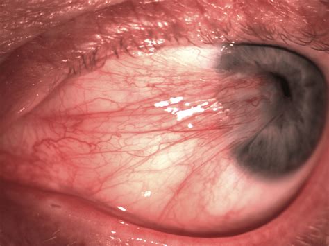 Whats That Red Thing On Your Eye Northpoint Eyecare