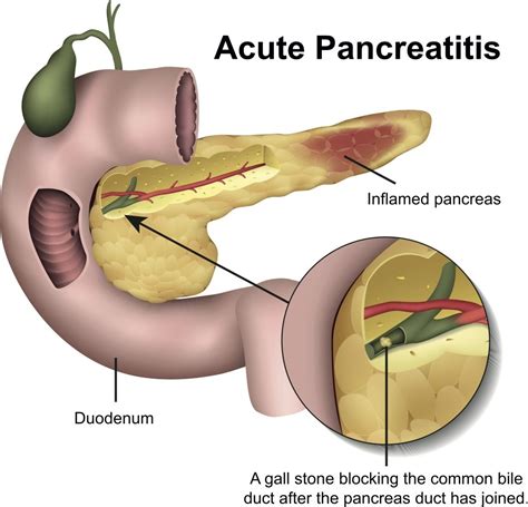 Pancreatitis And Pancreatic Insufficiency Gastro IQ
