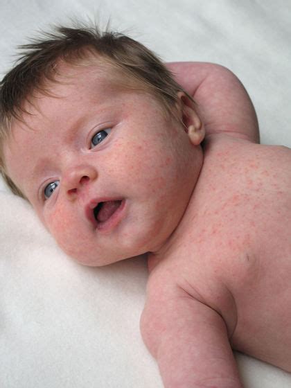 Baby Rash Roseola Pictures Photos