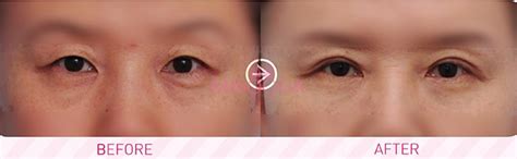 Why Korean Blepharoplasty Surgery Is Different Guide Reviews