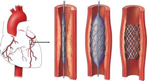 What You Need To Know About A Heart Stent Central Georgia Heart Center