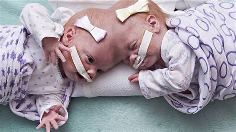 10 month old twins joined at the head successfully separated in philadelphia hospital national