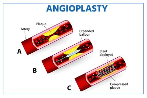 Angioplasty Know The Types Procedures Risks And Recovery
