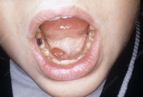 Ranula In A Mouth Stock Image C0235739 Science Photo Library