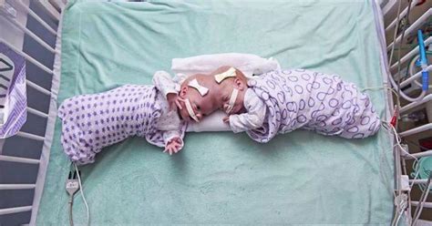 Formerly Conjoined Twins Thriving After Rare Complex Surgery Separated Their Brains Cbs News