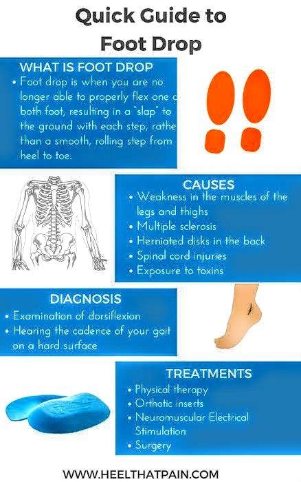 Causes Of Foot Drop Pt Master Guide