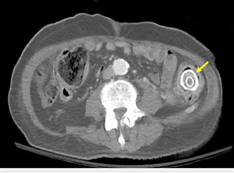 Ct Abdomen Pelvis Shows Large Lamellated Stone In The Distal Descending