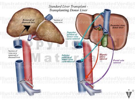 Stock Liver Surgeries Transplants — Illustrated Verdict