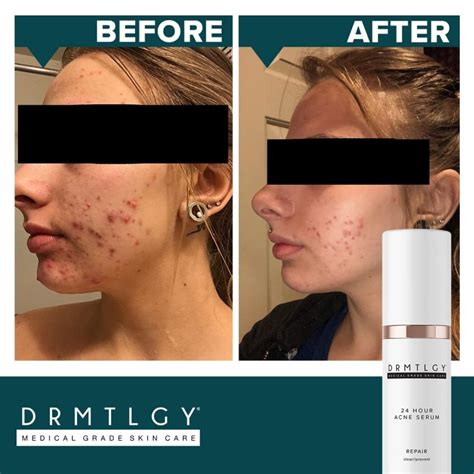 You Have To See The Before And After Snaps Of This Cystic Acne