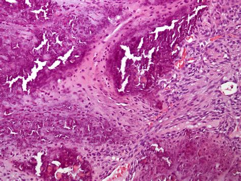 Pathology Outlines Calcifying Aponeurotic Fibroma