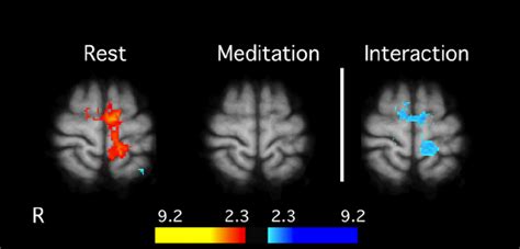 Interaction Between Meditation And Pain Related Brain Activation In Mri Download Scientific