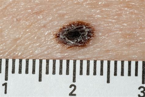 Junctional Melanocytic Nevus