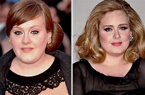 Adeles Before And After Surgery Photos Show Proof Of The Singers