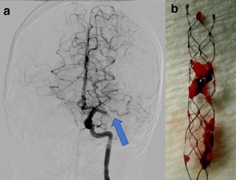A Cerebral Angiogram From A Young Patient With An Acute Ischemic Stroke
