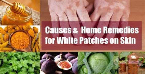 Best Home Remedies To Get Rid Of White Patches On Skin Vitiligo Causes