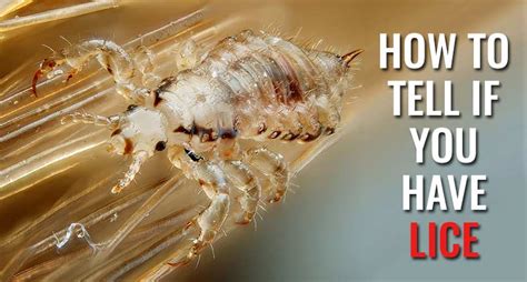 How To Tell If You Have Lice Pay Attention To These 5 Signals