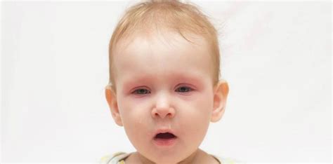 Mata Merah Pada Bayi Penyebab Gejala Dan Cara Mengatasi