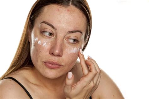How To Remove Sun Spots Naturally With 8 At Home Remedies