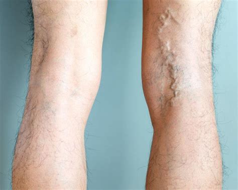 What Are The Best Ways To Treat Bulging Varicose Veins Blog South
