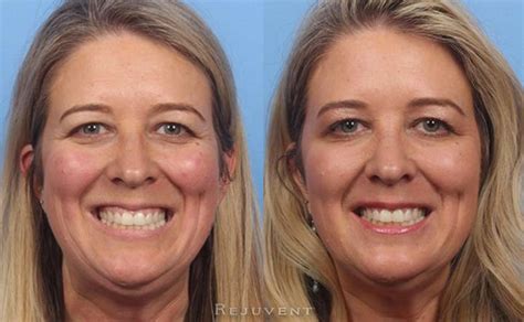 Botox Laugh Lines Before And After