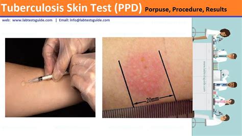 Tuberculin Skin Test TST Purpose Procedure Result And More