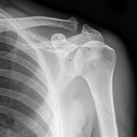 Approach To Traumatic Shoulder Pain Core Em